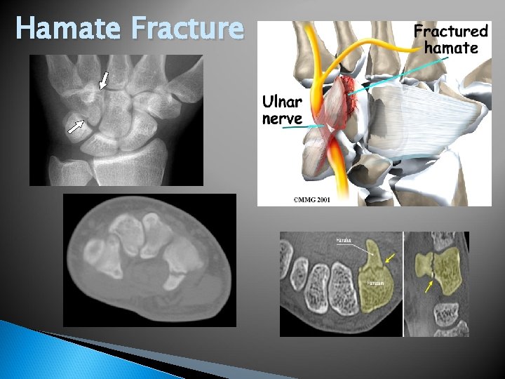 Hamate Fracture 