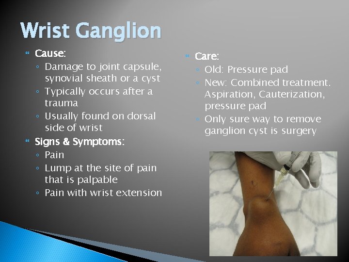 Wrist Ganglion Cause: ◦ Damage to joint capsule, synovial sheath or a cyst ◦