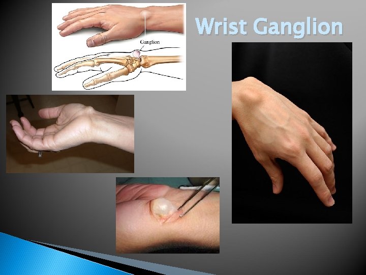 Wrist Ganglion 