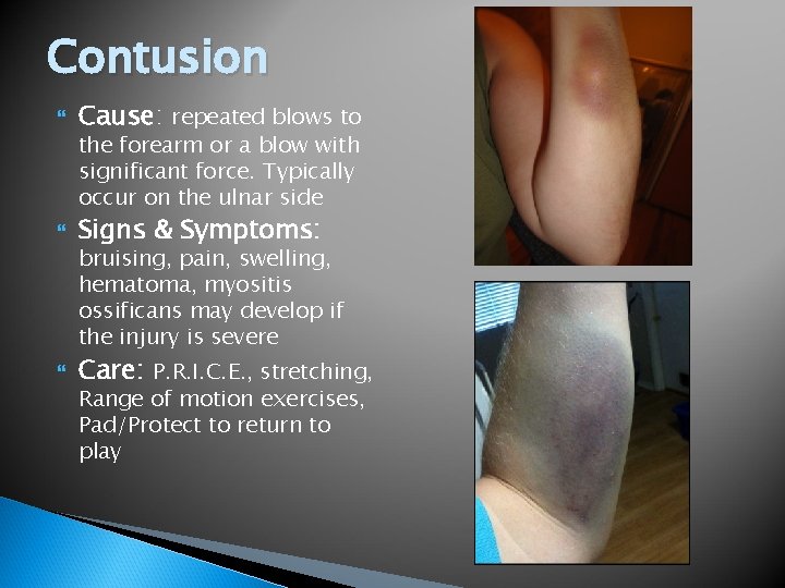 Contusion Cause: repeated blows to Signs & Symptoms: Care: P. R. I. C. E.