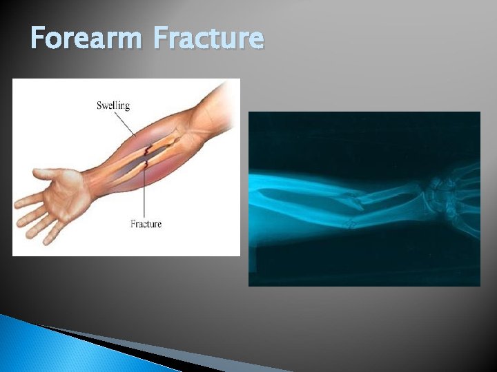 Forearm Fracture 