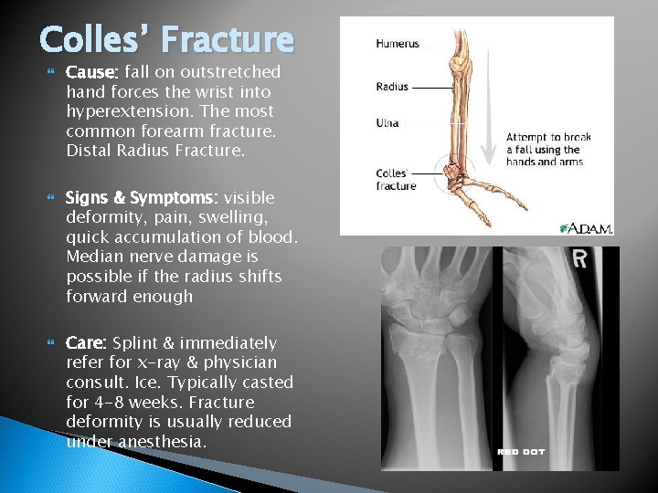 Colles’ Fracture Cause: fall on outstretched hand forces the wrist into hyperextension. The most