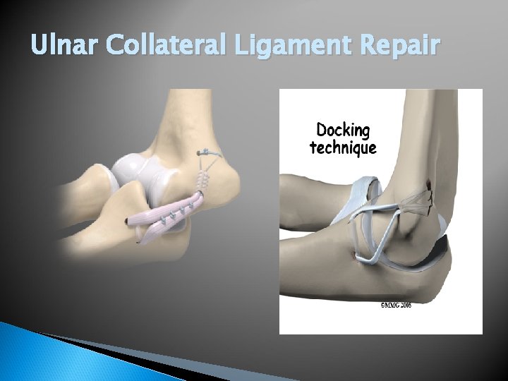 Ulnar Collateral Ligament Repair 