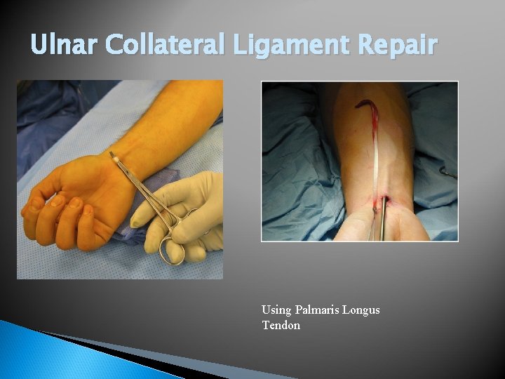 Ulnar Collateral Ligament Repair Using Palmaris Longus Tendon 