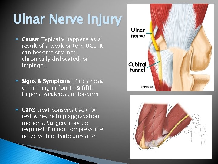 Ulnar Nerve Injury Cause: Typically happens as a result of a weak or torn