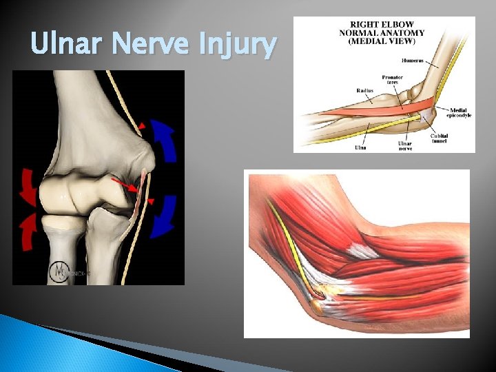 Ulnar Nerve Injury 