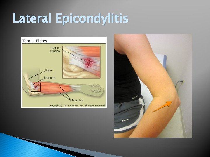 Lateral Epicondylitis 