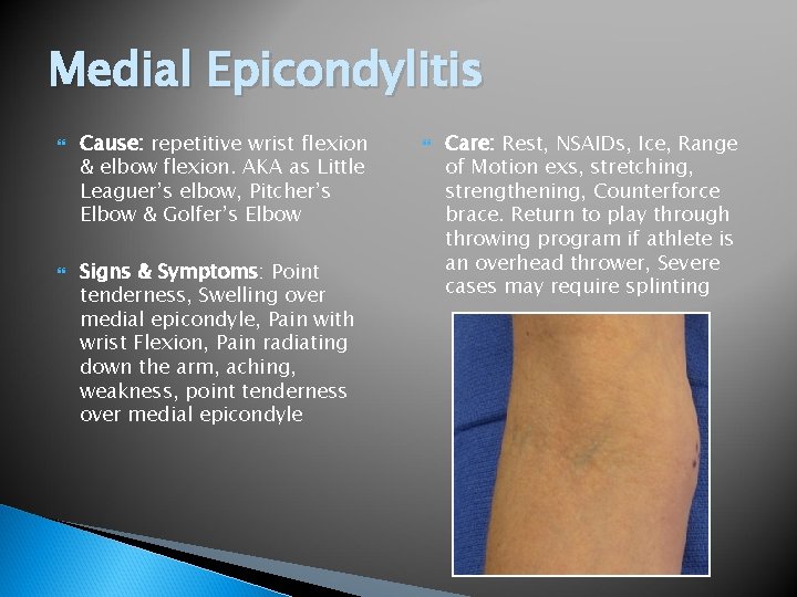 Medial Epicondylitis Cause: repetitive wrist flexion & elbow flexion. AKA as Little Leaguer’s elbow,