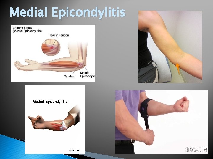 Medial Epicondylitis 