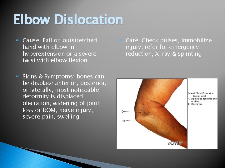 Elbow Dislocation Cause: Fall on outstretched hand with elbow in hyperextension or a severe
