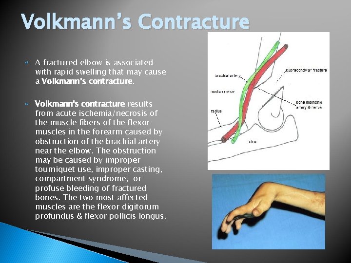 Volkmann’s Contracture A fractured elbow is associated with rapid swelling that may cause a