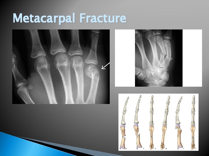 Metacarpal Fracture 