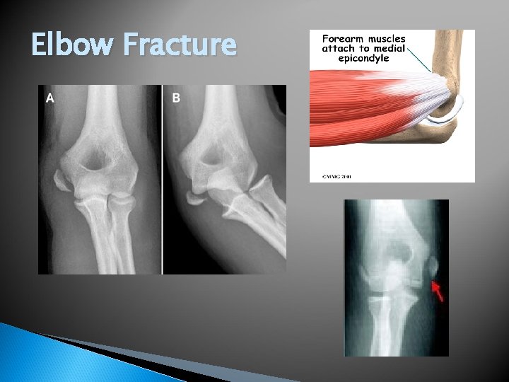 Elbow Fracture 