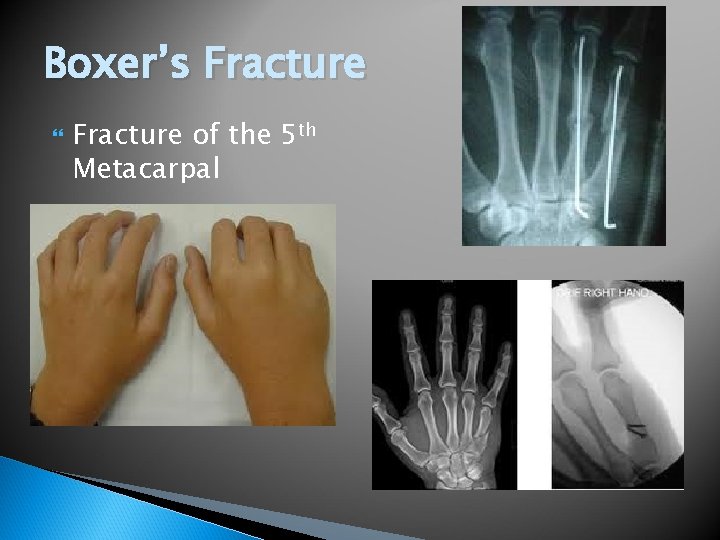 Boxer’s Fracture of the 5 th Metacarpal 