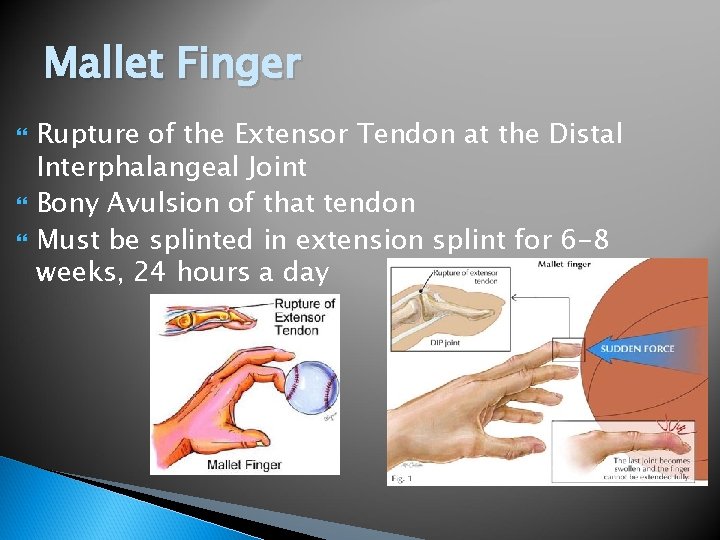 Mallet Finger Rupture of the Extensor Tendon at the Distal Interphalangeal Joint Bony Avulsion