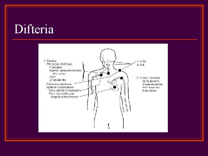 Difteria 