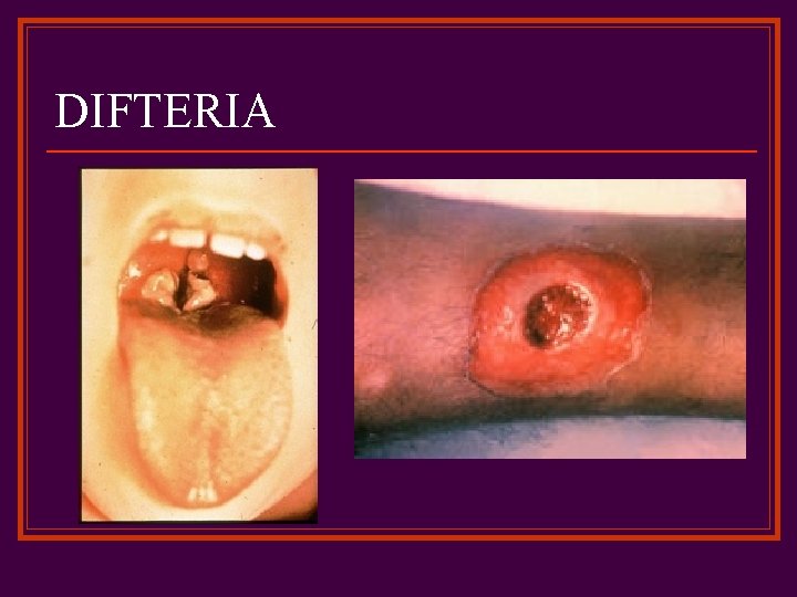 DIFTERIA 
