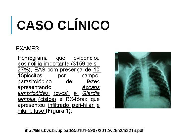 CASO CLÍNICO EXAMES Hemograma que evidenciou eosinofilia importante (3159 cels - 27%), EAS com
