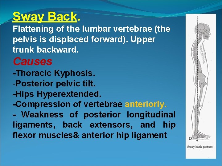 Sway Back. Flattening of the lumbar vertebrae (the pelvis is displaced forward). Upper trunk