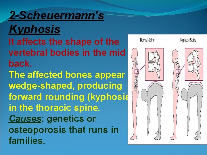 2 -Scheuermann's Kyphosis It affects the shape of the vertebral bodies in the mid