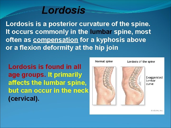 Lordosis is a posterior curvature of the spine. It occurs commonly in the lumbar