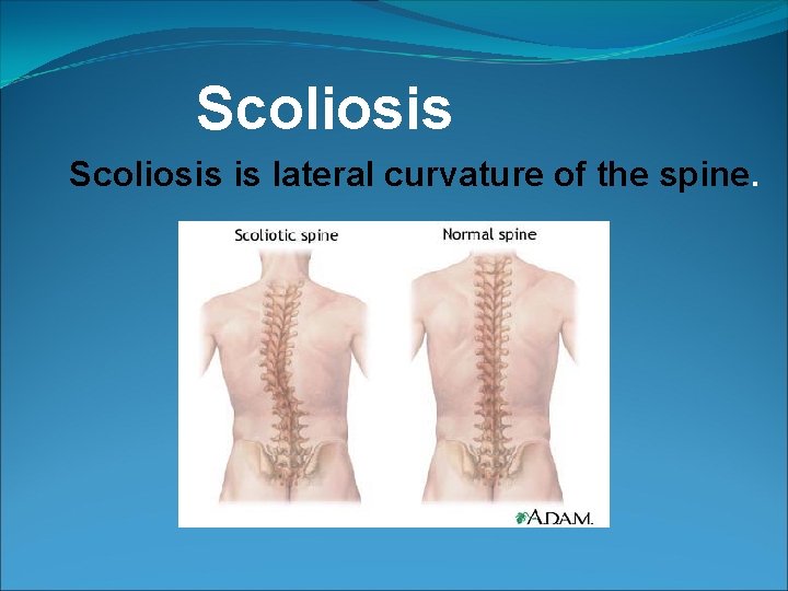 Scoliosis is lateral curvature of the spine. 