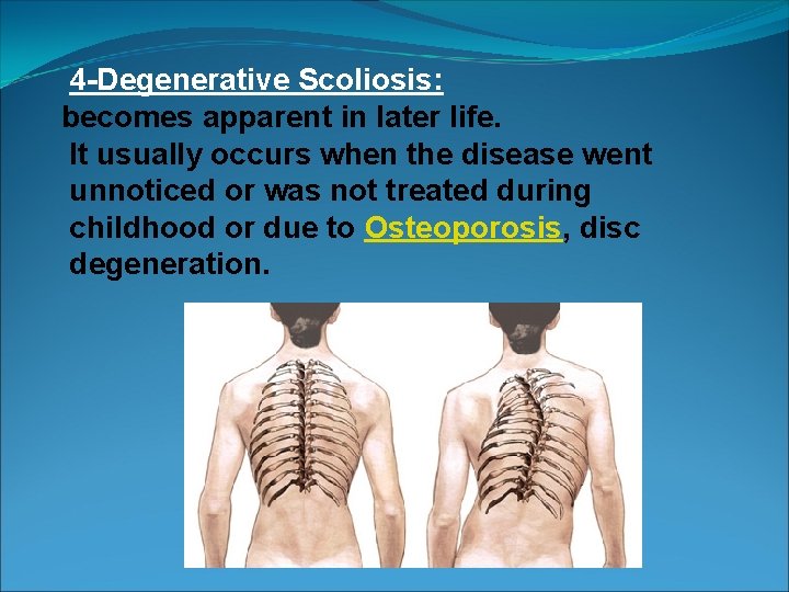 4 -Degenerative Scoliosis: becomes apparent in later life. It usually occurs when the disease