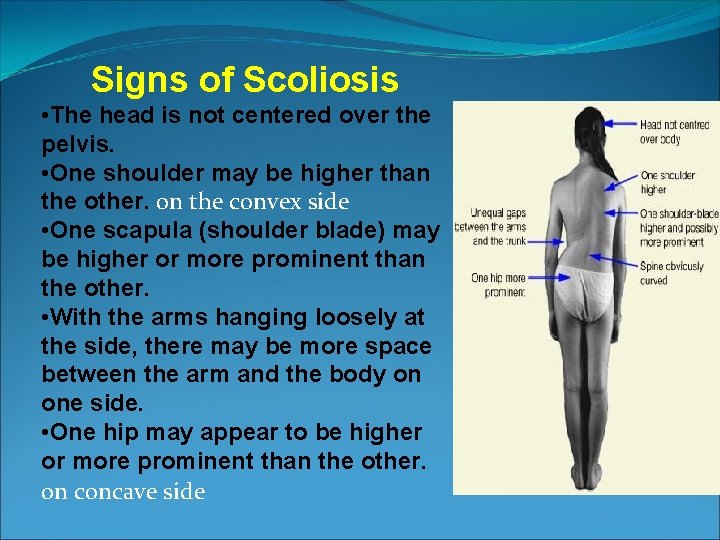 Signs of Scoliosis • The head is not centered over the pelvis. • One