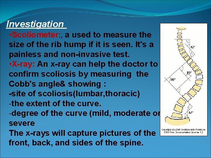 Investigation • Scoliometer: , a used to measure the size of the rib hump
