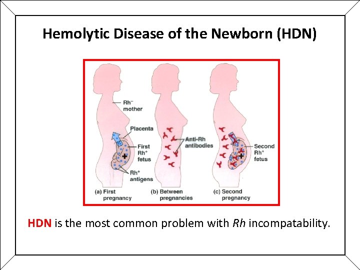 Hemolytic Disease of the Newborn (HDN) HDN is the most common problem with Rh Hemolytic Disease of the Newborn (HDN) HDN is the most common problem with Rh
