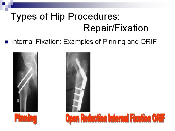 Types of Hip Procedures: Repair/Fixation n Internal Fixation: Examples of Pinning and ORIF 