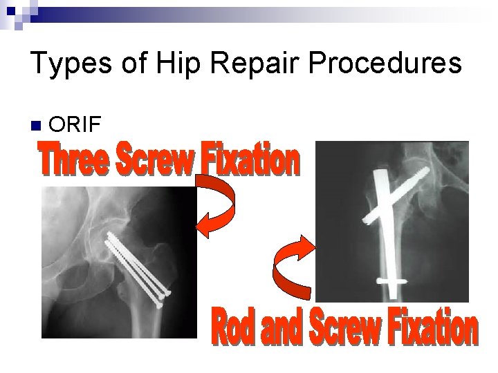 Types of Hip Repair Procedures n ORIF 