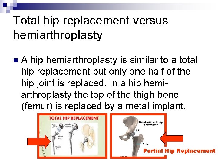 Total hip replacement versus hemiarthroplasty n A hip hemiarthroplasty is similar to a total