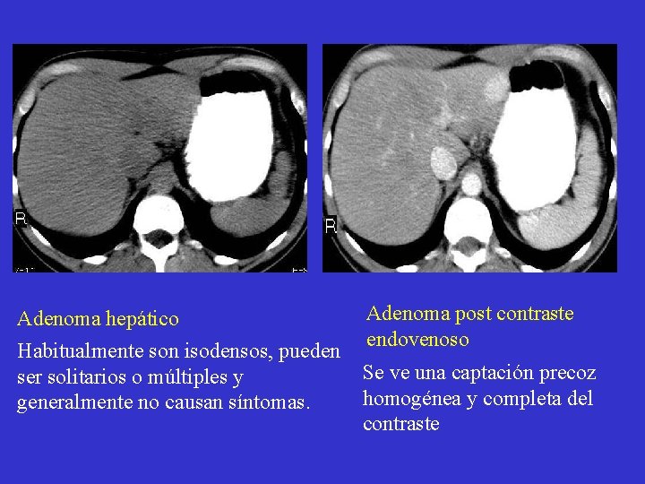 Adenoma hepático Habitualmente son isodensos, pueden ser solitarios o múltiples y generalmente no causan