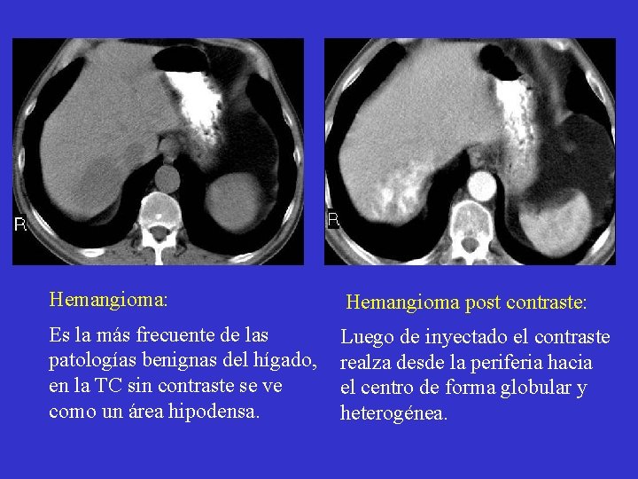 Hemangioma: Hemangioma post contraste: Es la más frecuente de las patologías benignas del hígado,