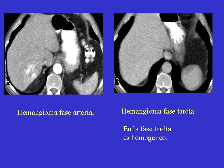 Hemangioma fase arterial Hemangioma fase tardía: En la fase tardía es homogéneo. 
