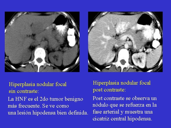 Hiperplasia nodular focal sin contraste: La HNF es el 2 do tumor benigno más