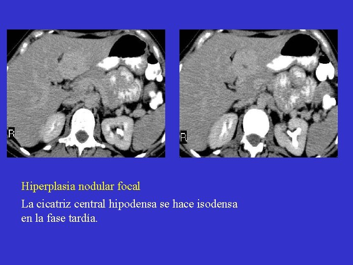 Hiperplasia nodular focal La cicatriz central hipodensa se hace isodensa en la fase tardía.