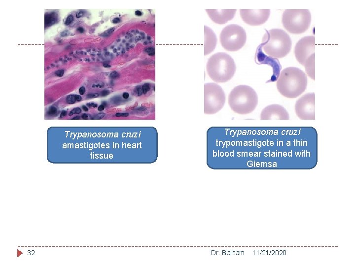 Trypanosoma cruzi amastigotes in heart tissue 32 Trypanosoma cruzi trypomastigote in a thin blood