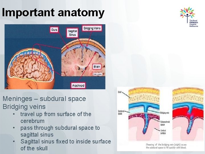 Important anatomy Meninges – subdural space Bridging veins • travel up from surface of