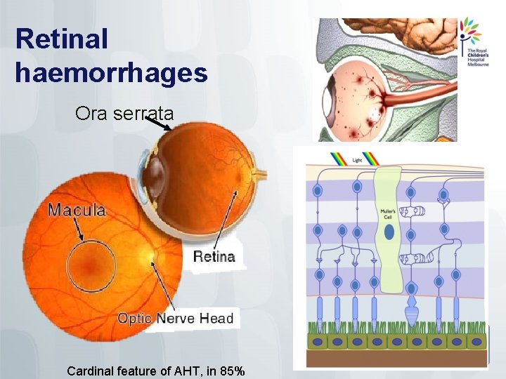 Retinal haemorrhages Ora serrata Cardinal feature of AHT, in 85% 15 