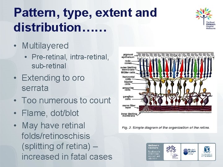 Pattern, type, extent and distribution…… • Multilayered • Pre-retinal, intra-retinal, sub-retinal • Extending to