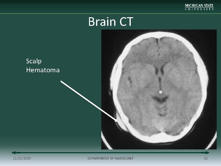 Brain CT Scalp Hematoma 11/21/2020 DEPARTMENT OF RADIOLOGY 16 