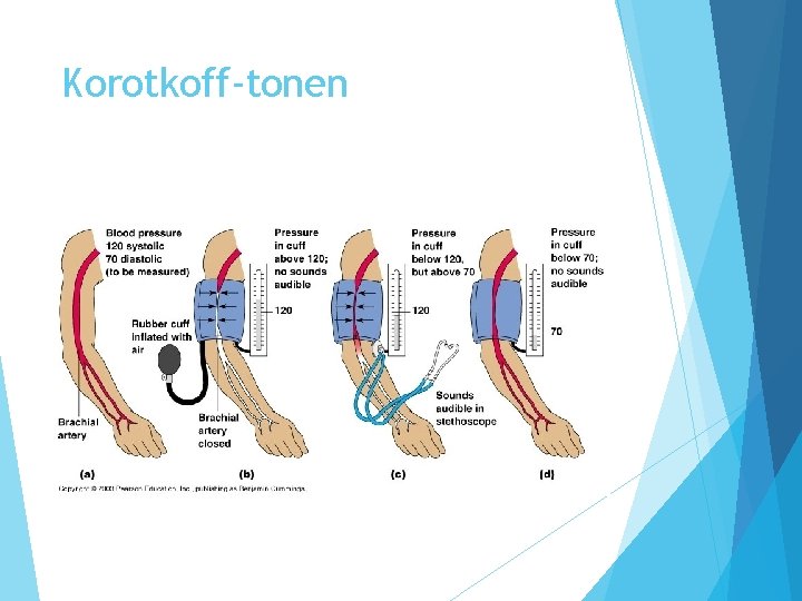 Korotkoff-tonen 
