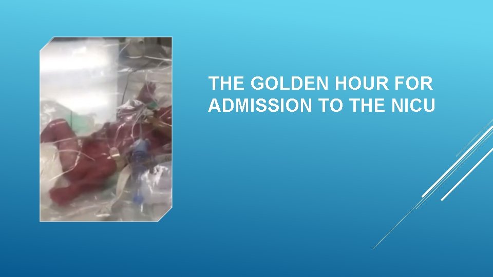 THE GOLDEN HOUR FOR ADMISSION TO THE NICU 