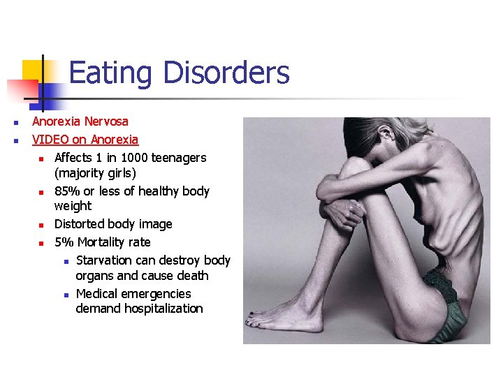 Eating Disorders n n Anorexia Nervosa VIDEO on Anorexia n Affects 1 in 1000