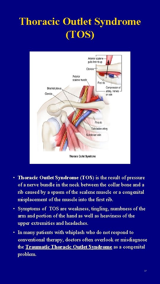 Thoracic Outlet Syndrome (TOS) • Thoracic Outlet Syndrome (TOS) is the result of pressure