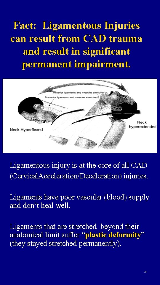 Fact: Ligamentous Injuries can result from CAD trauma and result in significant permanent impairment.