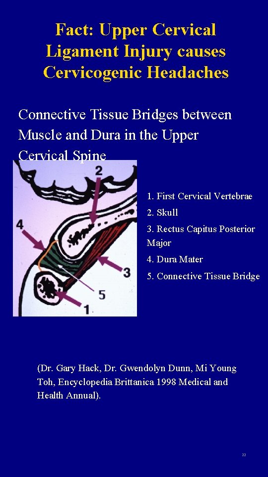 Fact: Upper Cervical Ligament Injury causes Cervicogenic Headaches Connective Tissue Bridges between Muscle and