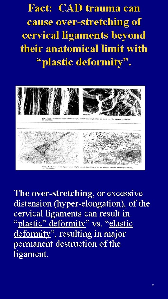 Fact: CAD trauma can cause over-stretching of cervical ligaments beyond their anatomical limit with